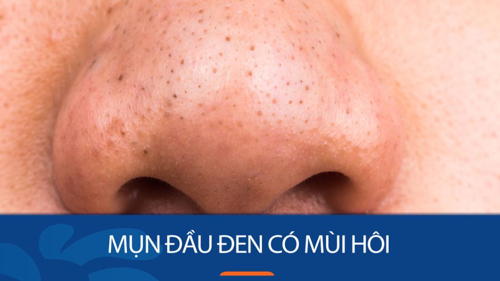 Mụn đầu đen có mùi hôi: Nguyên nhân và 6 giải pháp “triệt tiêu” tận gốc