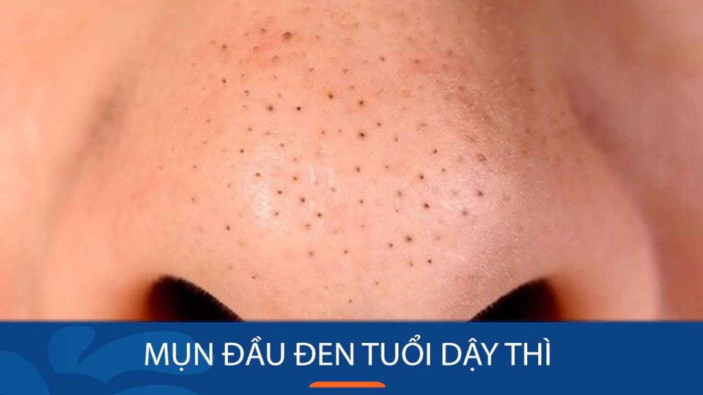Mụn đầu đen tuổi dậy thì – Đánh bay hoàn toàn chỉ sau 7 ngày