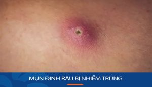 Mụn đinh râu bị nhiễm trùng: Nguyên nhân, dấu hiệu và cách điều trị hiệu quả