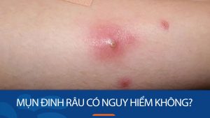 [Giải đáp] Mụn đinh râu có nguy hiểm? 3 giai đoạn phát triển và cách xử lý