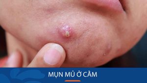 Mụn mủ ở cằm: Cách trị mụn mủ ở cằm hiệu quả trong 3 ngày