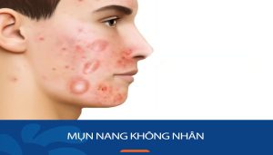 Mụn nang không nhân: Cách trị mụn nang không nhân hiệu quả nhanh chóng