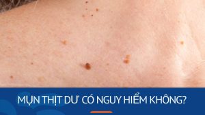 Mụn thịt dư có nguy hiểm không? Bí quyết đánh bay mụn thịt dư chỉ trong 7 ngày