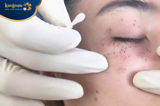 Đốt mụn thịt trên mặt bằng laser