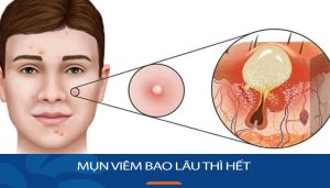 Mụn viêm bao lâu thì hết? Bí quyết đẩy lùi mụn viêm hiệu quả trong thời gian ngắn