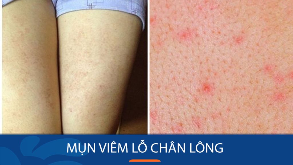 Mụn viêm lỗ chân lông: Bí quyết loại bỏ mụn viêm lỗ chân lông tận gốc