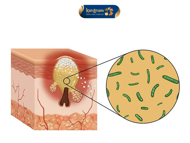 Vi khuẩn P.acnes sẽ xâm nhập qua lỗ chân lông bít tắc gây ra mụn viêm 