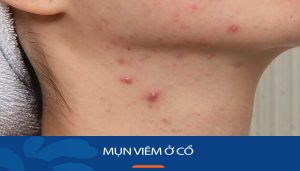 Cách trị mụn viêm ở cổ hiệu quả, không để lại sẹo thâm