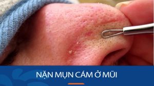 Nặn Mụn Cám Mũi Hiệu Quả: Bí Quyết Giữ Làn Da Mịn Màng