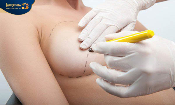 Nâng ngực để khắc phục ngực chảy xệ