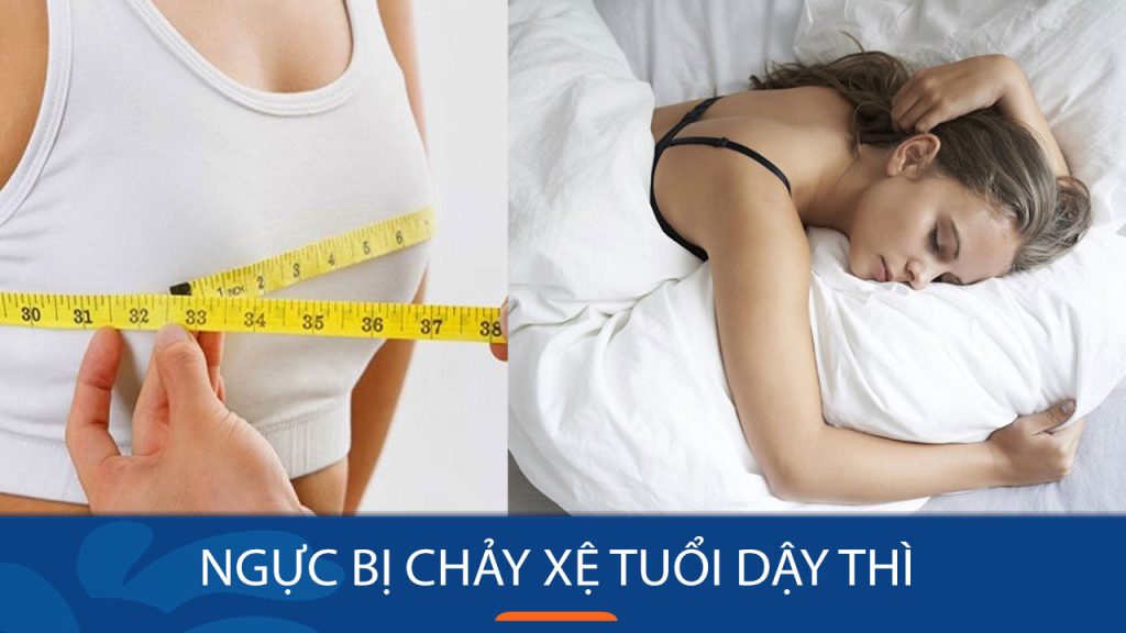 Ngực bị chảy xệ tuổi dậy thì nguyên nhân do đâu?