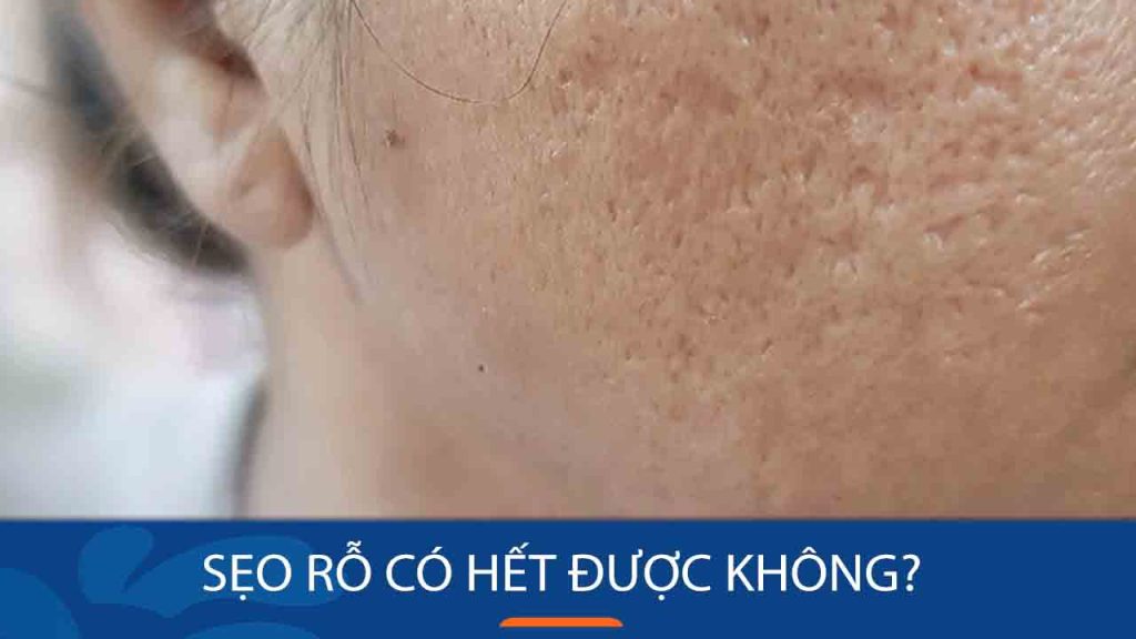 Sẹo rỗ có hết được không? Giải đáp thắc mắc và so sánh các phương pháp điều trị hiệu quả
