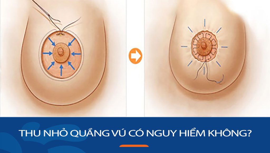 Thu nhỏ quầng vú có nguy hiểm không? Giải đáp từ chuyên gia