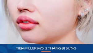 Tiêm filler môi 2 tháng bị sưng: Nguyên nhân và cách khắc phục