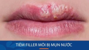 Tiêm filler môi nổi mụn nước: Nguy hiểm hay không?