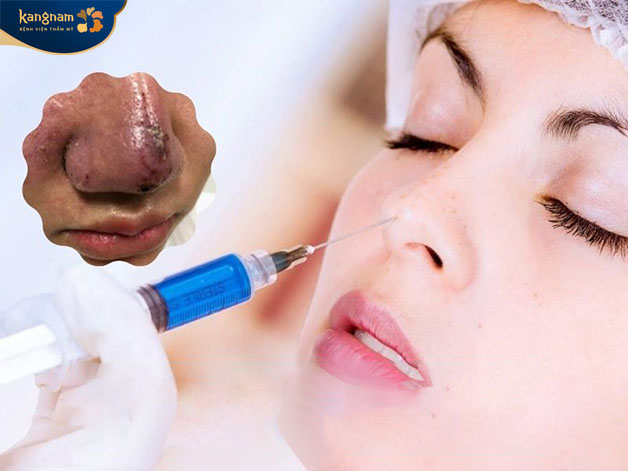 Người thực hiện tiêm sai cách sẽ khiến filler bị tràn 