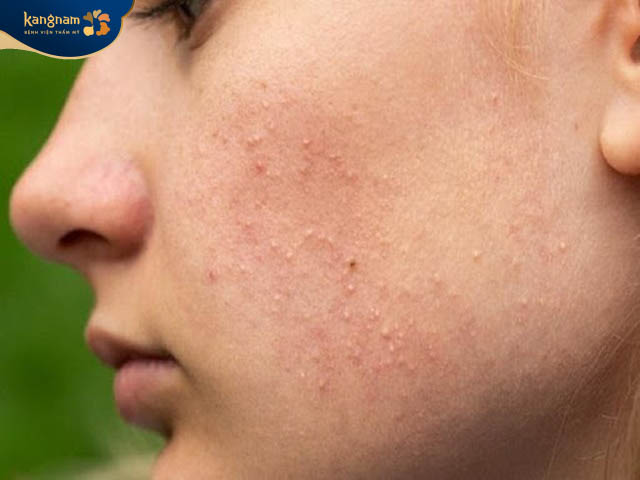 Mụn ẩn do nhiều bít tắc lỗ chân lông gây nên