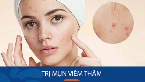 Cách trị mụn viêm thâm hiệu quả NHANH CHÓNG – TOP 6 sản phẩm được bác sĩ khuyên dùng