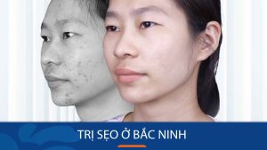 Địa chỉ Trị sẹo tại Bắc Ninh – phác đồ điều trị riêng, an toàn