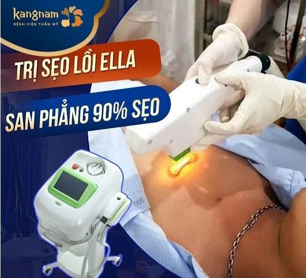 Trị sẹo lồi công nghệ Ella được ứng dụng tại Kangnam Bắc Ninh