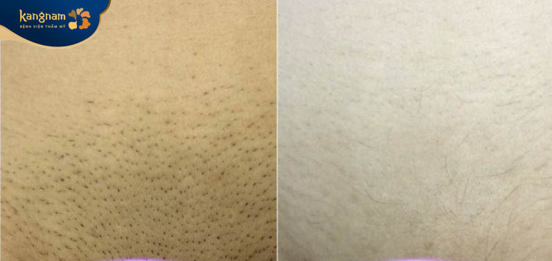 Triệt lông vùng kín loại bỏ tình trạng viêm nang lông