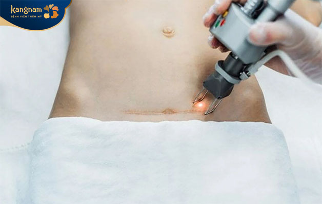 Phương pháp điều trị sẹo bằng tia Laser được ứng dụng tại nhà spa, thẩm mỹ viện 