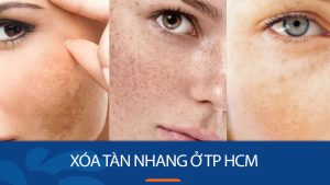 Xóa tàn nhang ở tp HCM: Bắn hết sạch tàn nhang uy tín, giá rẻ