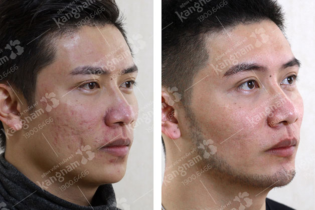 Xóa bỏ sẹo rỗ, lấy lại làn da láng mịn, đều màu