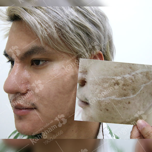 Sẹo rỗ lâu năm được "xóa sổ" sau 1 liệu trình