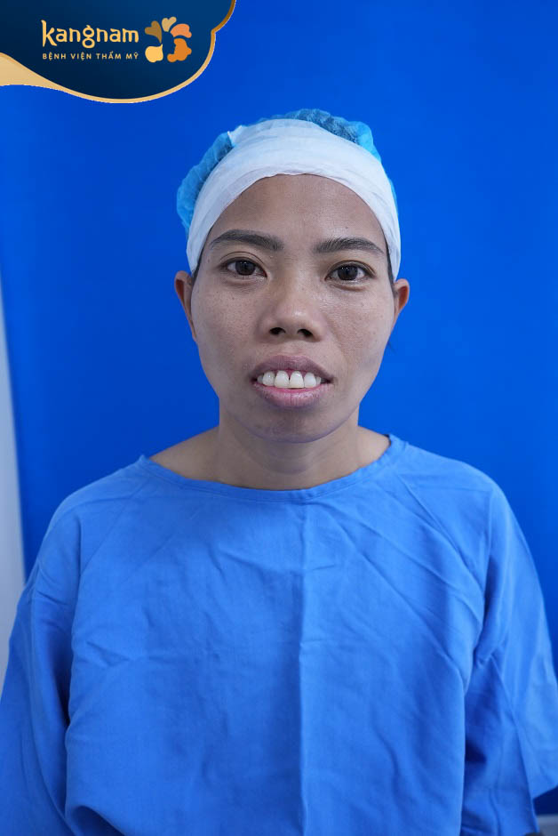 Nguyễn Thị Nhì với khuyết điểm hàm hô nặng