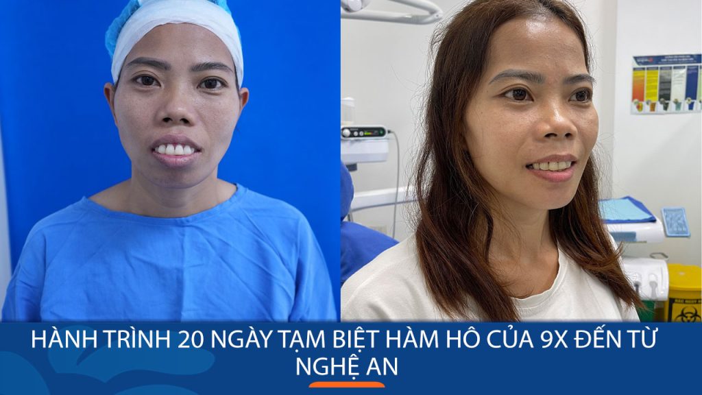 Hành trình 20 ngày thay đổi, tạm biệt hàm hô của 9x đến từ Nghệ An