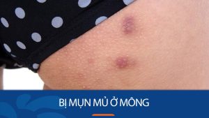 Bị Mụn Mủ Ở Mông: Nguyên Nhân, Cách Điều Trị & Phòng Ngừa Hiệu Quả