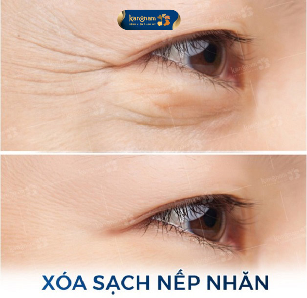 Dòng chỉ Xline trẻ hóa vùng mắt là một trong những dòng chỉ được thiết kế chuyên biệt cho vùng da này