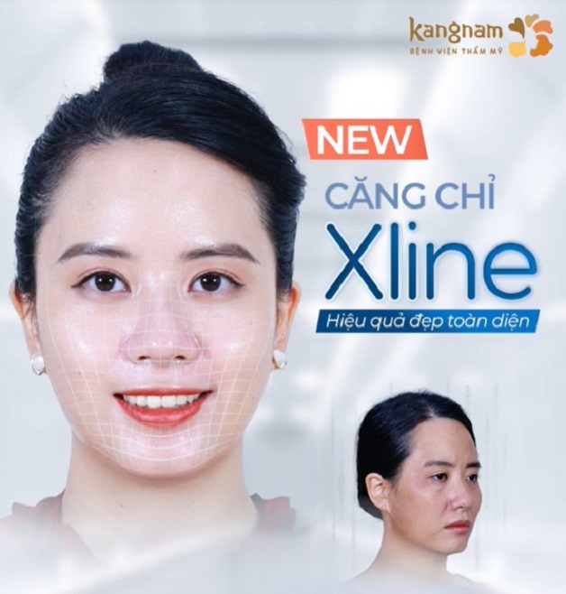Căng chỉ Xline là phương pháp làm đẹp sử dụng chỉ Xline Thụy Sĩ để làm trẻ hóa da