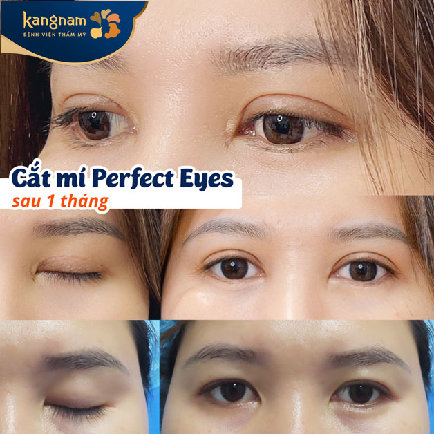 Cắt mí Perfect Eyes