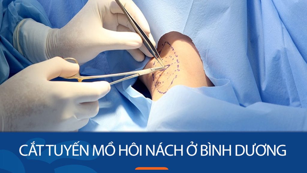 Địa chỉ cắt tuyến mồ hôi nách ở Bình Dương uy tín