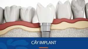 Cấy Implant – Phục hồi sự tự tin với hàm răng chắc khỏe