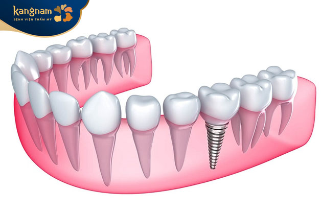 Cấy ghép Implant là kỹ thuật trồng răng giả tiên tiến trong lĩnh vực nha khoa