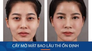 Cấy mỡ mặt bao lâu thì ổn định? quá trình và chế độ ăn uống