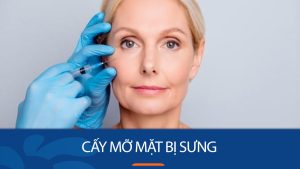 Tại sao cấy mỡ mặt bị sưng? Cách giảm sưng sau khi cấy mỡ mặt