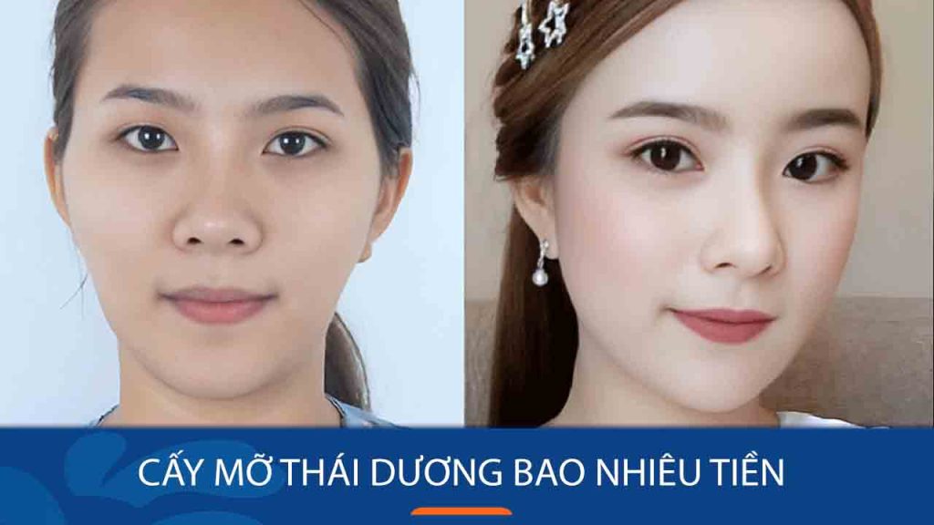 Cấy mỡ thái dương bao nhiêu tiền? Yếu tố ảnh hưởng đến giá