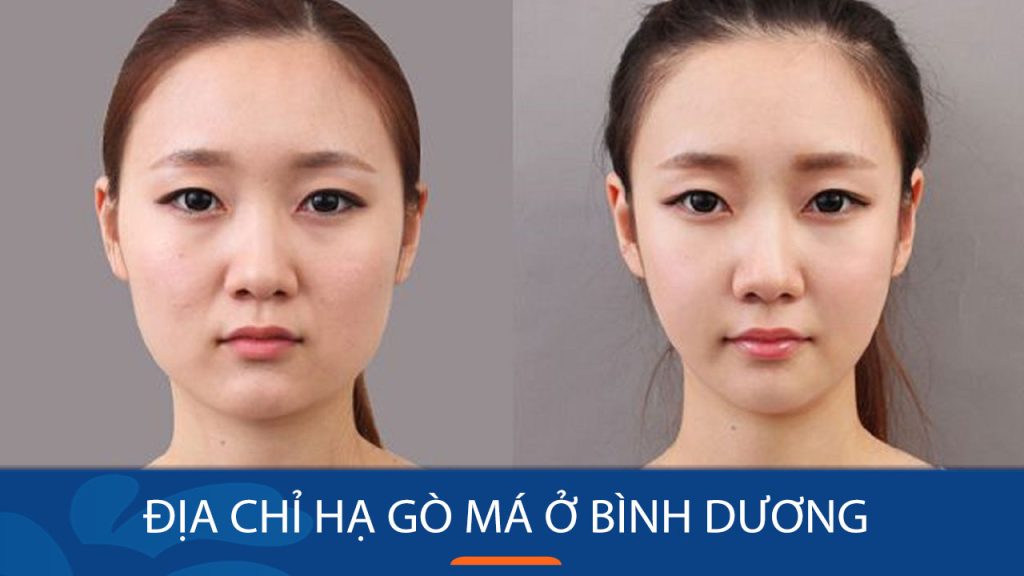 Địa chỉ hạ gò má ở Bình Dương Uy tín – tốt nhất hiện nay!