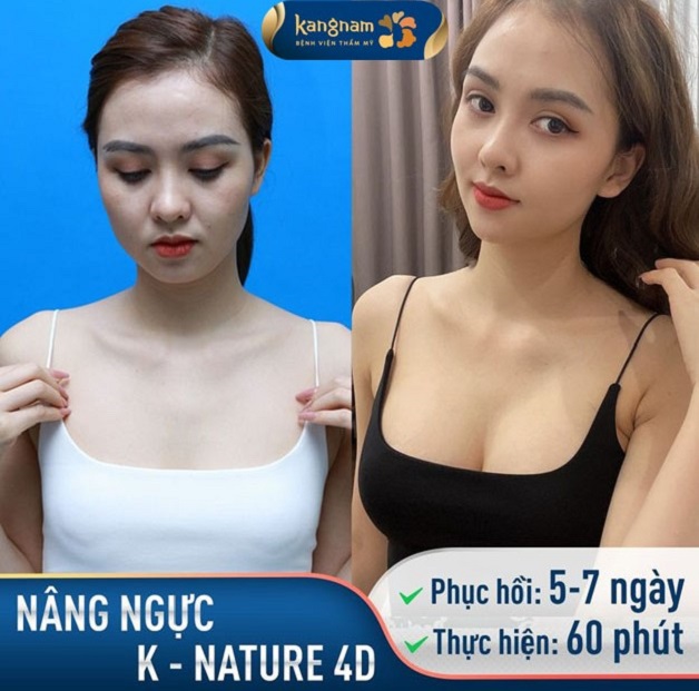 Công nghệ nâng ngực K-Nature 4D đang được ứng dụng tại Kangnam Bình Dương