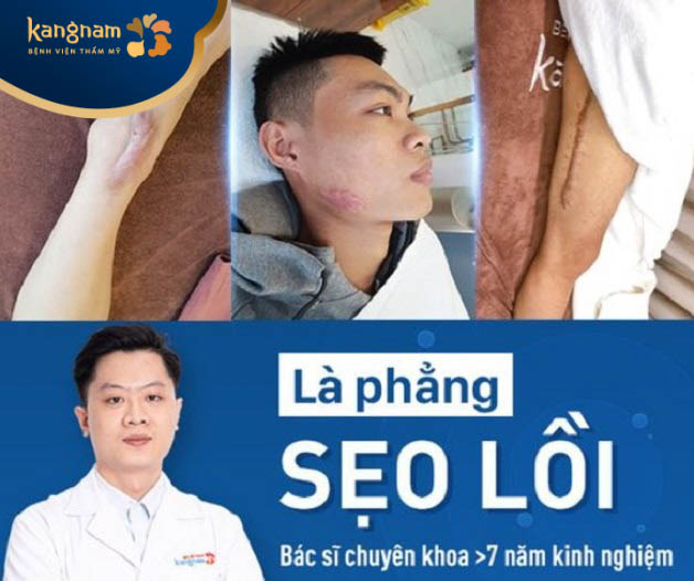 Kangnam nổi tiếng với dịch vụ là phẳng sẹo lồi