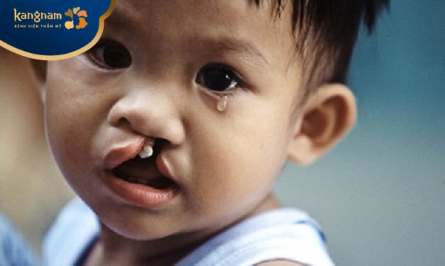 Răng miệng có thể phát triển không bình thường do trẻ bị hở hàm