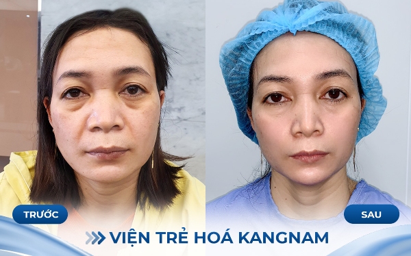 Chị Phương Lan - 55 tuổi sau khi thực hiện Căng da