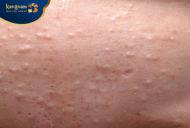 Các sản phẩm không tương thích với làn da khi sử dụng có thể gây mụn sâu bên trong lỗ chân lông