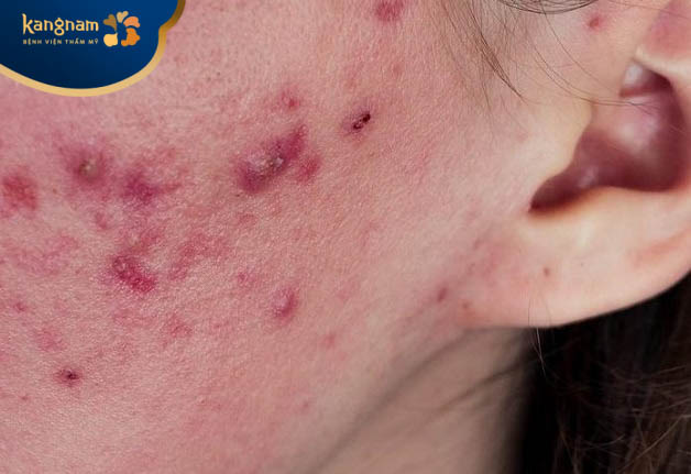 Nặn mụn bọc làm tổn thương vùng da xung quanh và dễ để lại sẹo xấu trên da