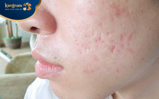 Mụn bọc nếu không được điều trị đúng cách có thể để lại sẹo thâm hoặc sẹo rỗ