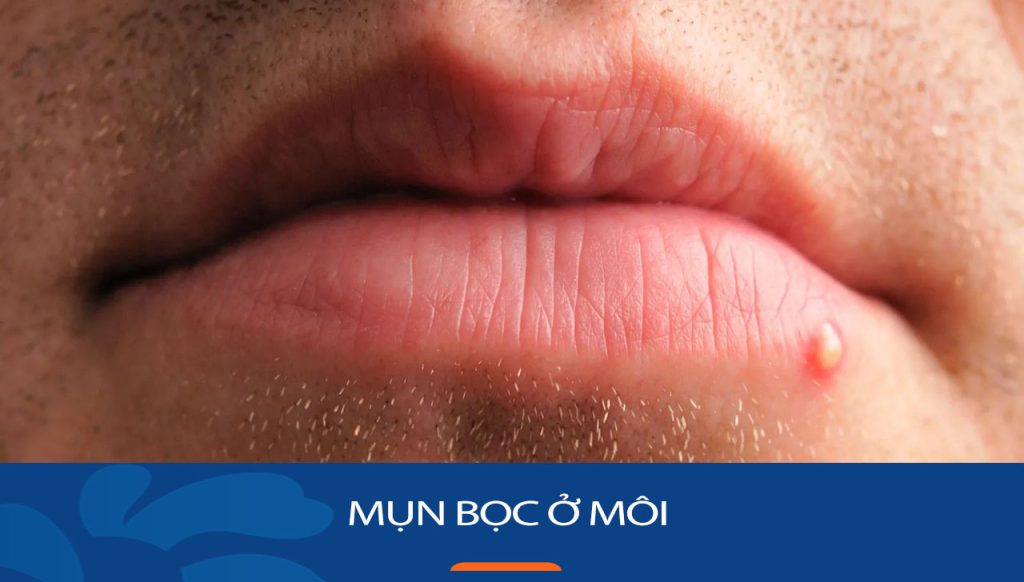Mụn bọc ở môi – KHÔNG LO NỮA với giải pháp điều trị từ thiên nhiên